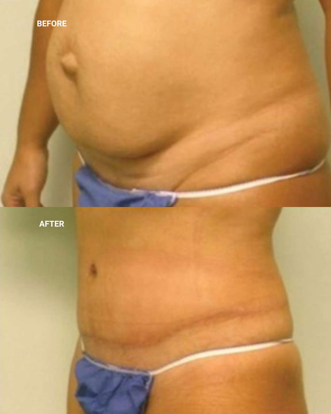 Body contouring before and after — 1010 Plastic Surgery