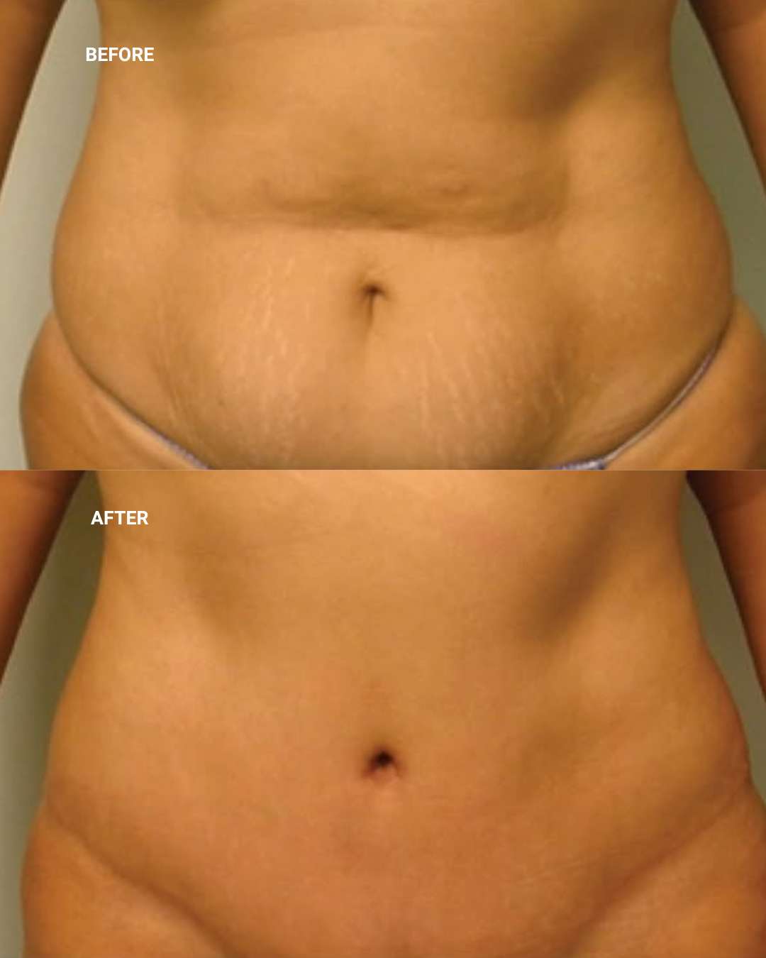 Body contouring before and after — 1010 Plastic Surgery
