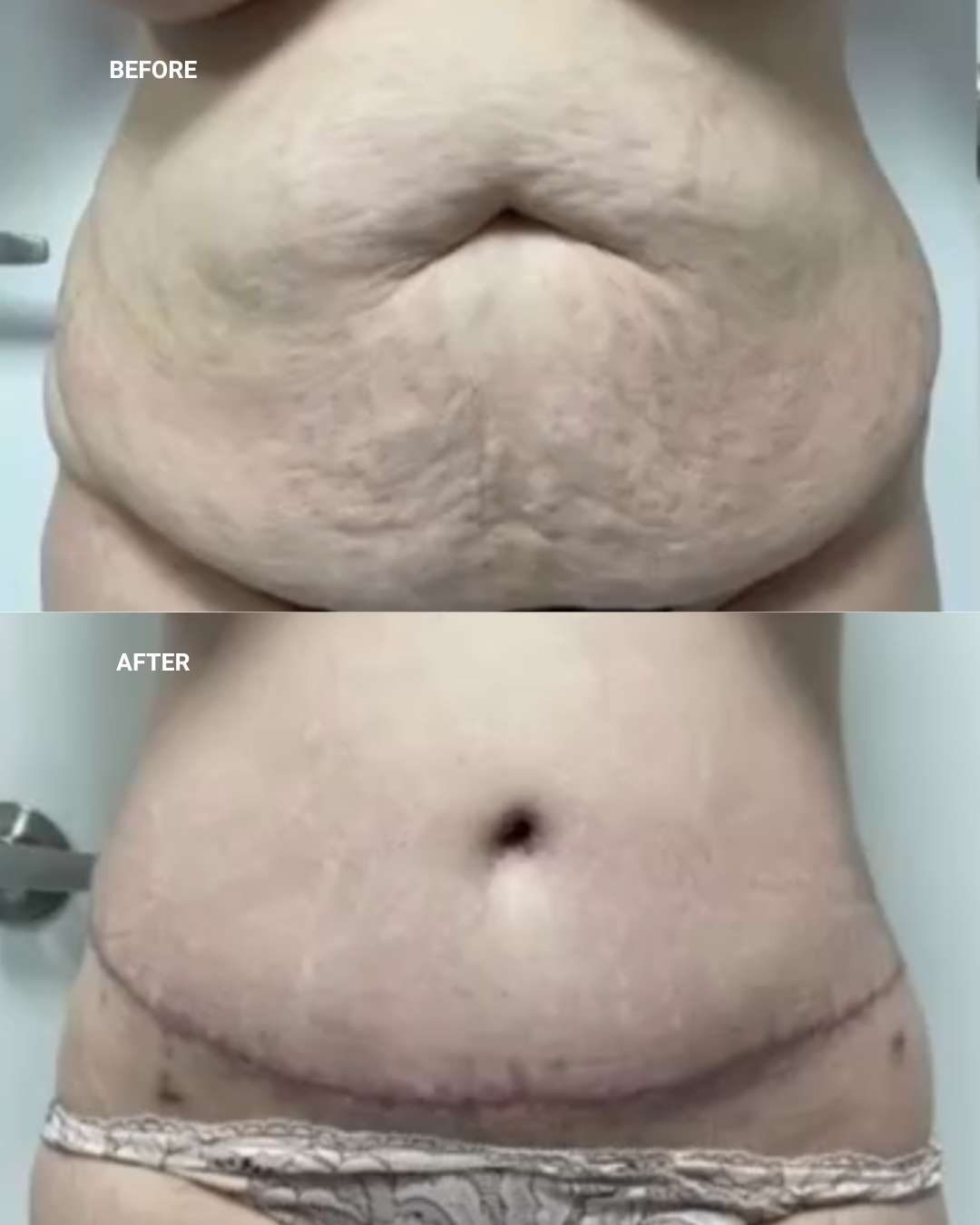 Body contouring before and after — 1010 Plastic Surgery