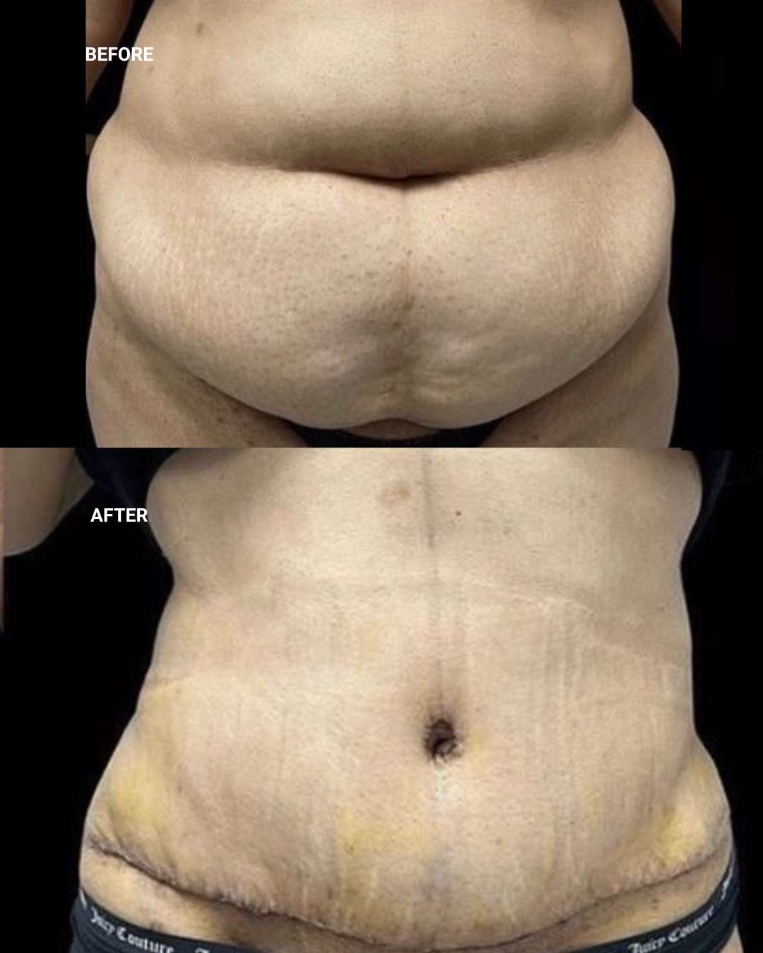 Body contouring before and after — 1010 Plastic Surgery