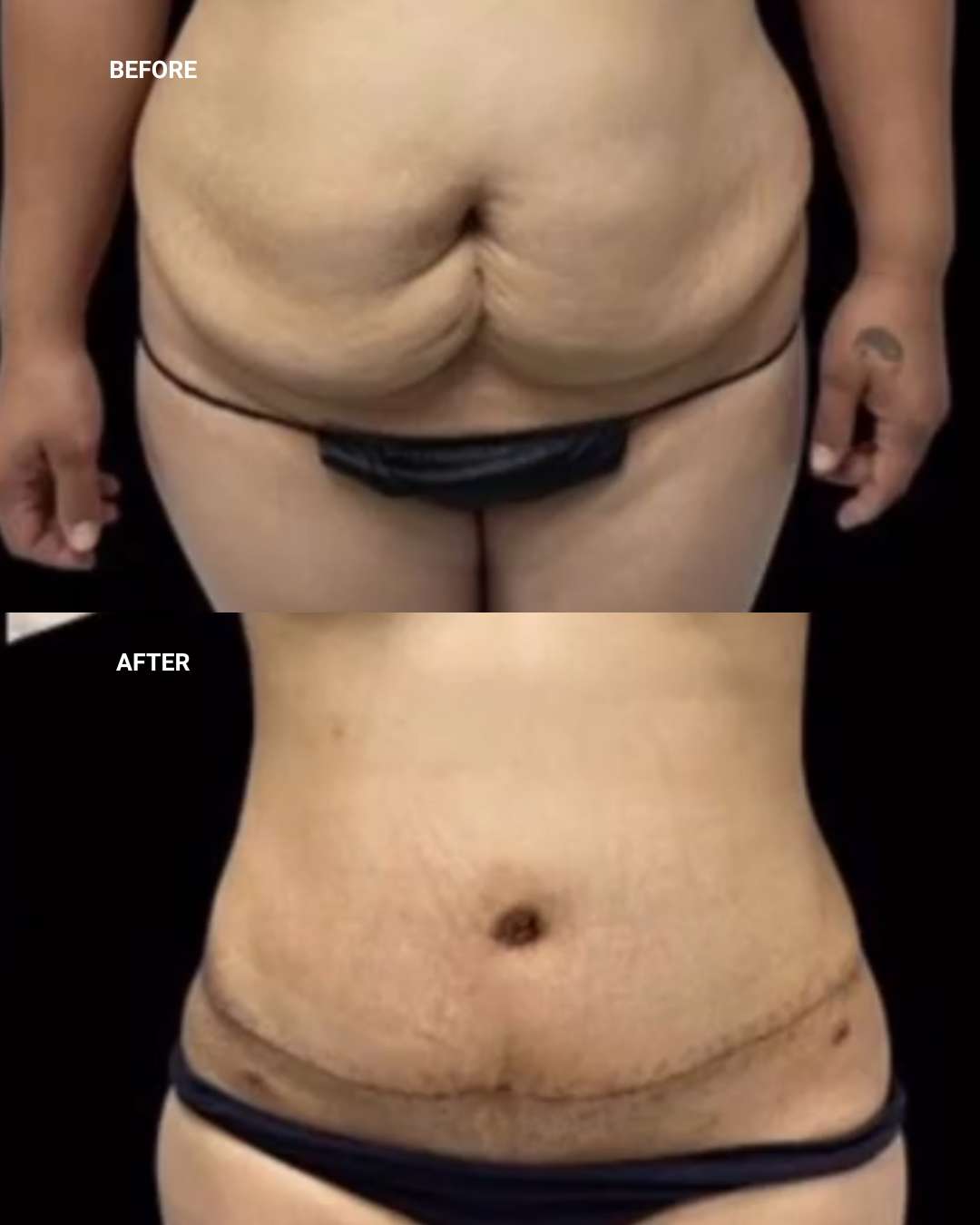Body contouring before and after — 1010 Plastic Surgery