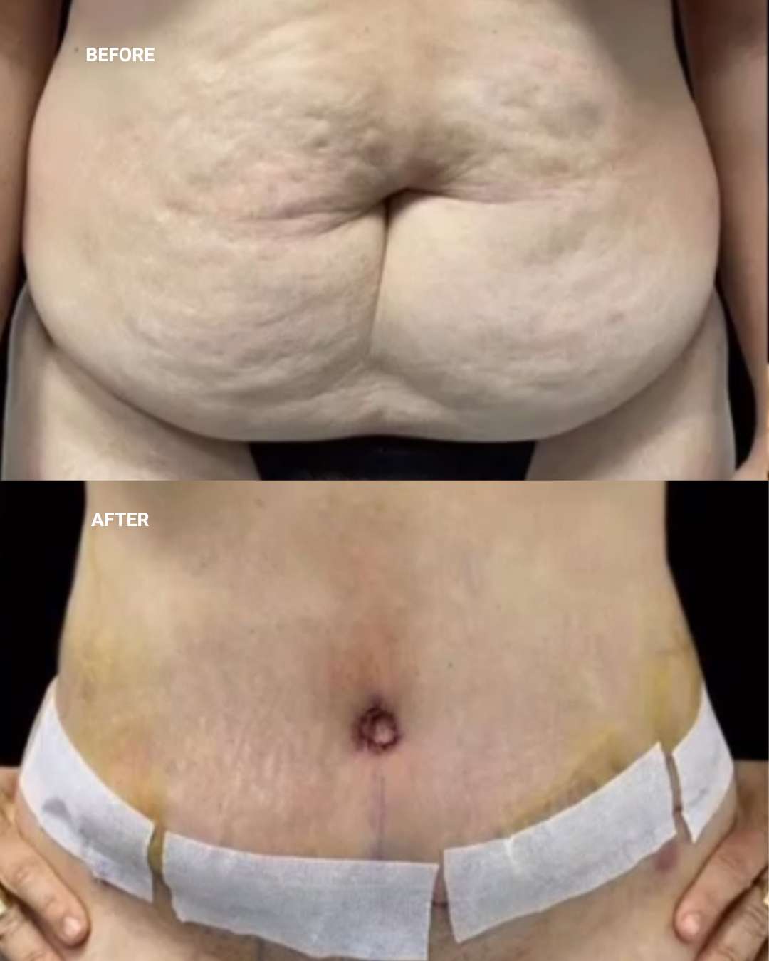 Body contouring before and after — 1010 Plastic Surgery
