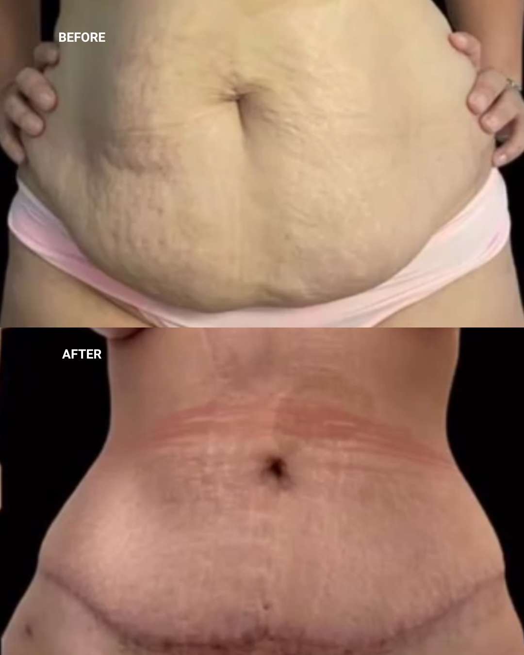 Body contouring before and after — 1010 Plastic Surgery