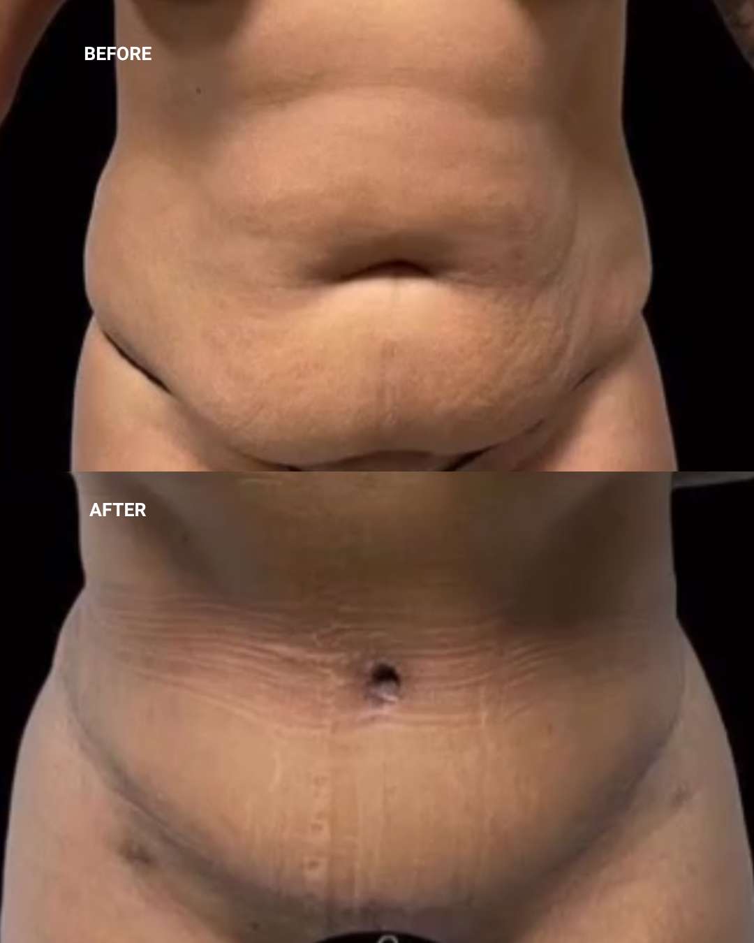 Body contouring before and after — 1010 Plastic Surgery