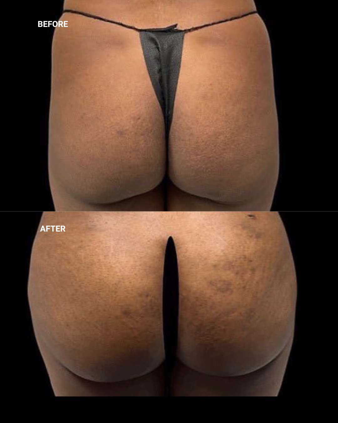 Body contouring before and after — 1010 Plastic Surgery