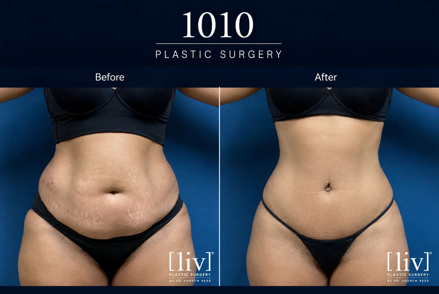 Body contouring before and after — 1010 Plastic Surgery
