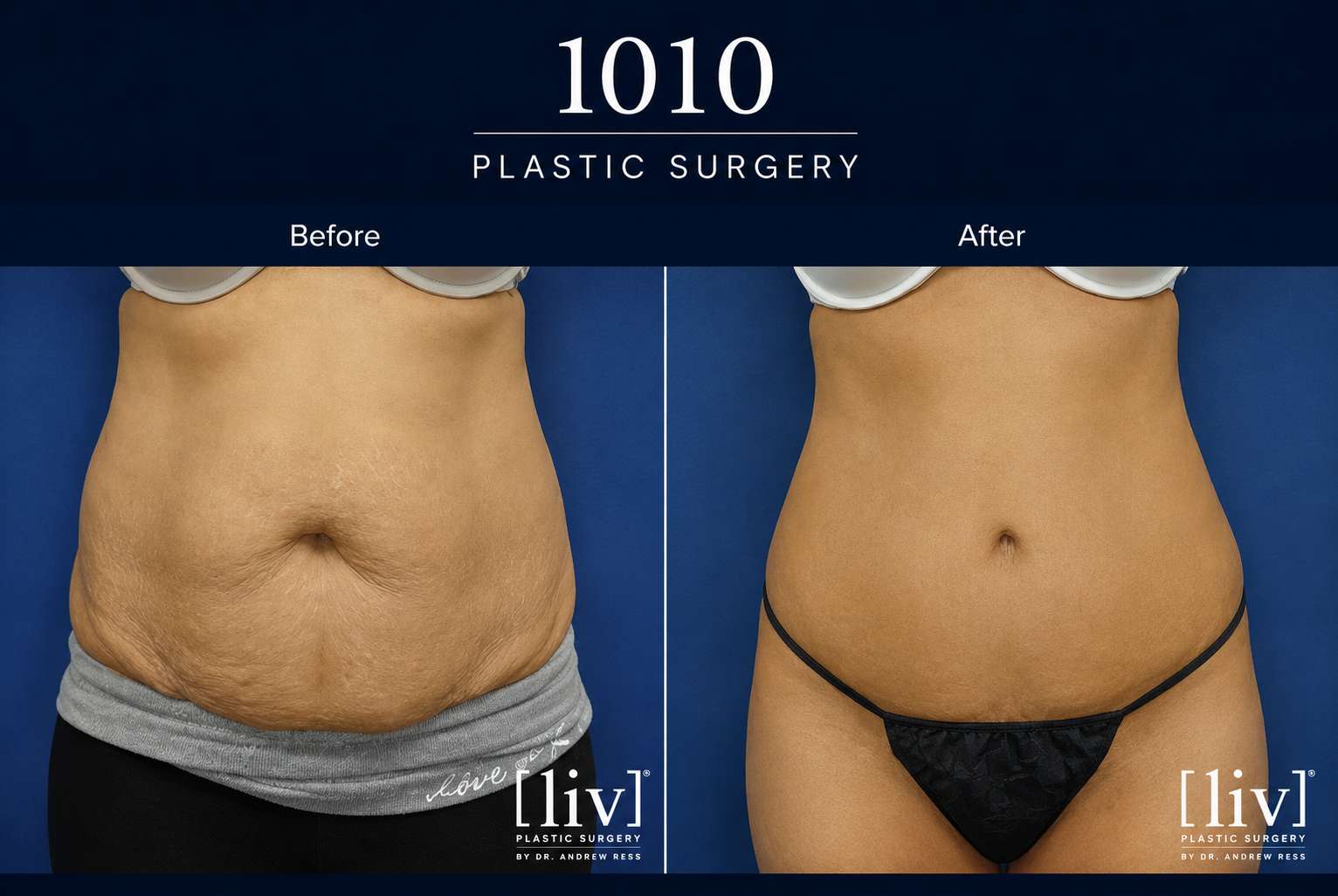 Body contouring before and after — 1010 Plastic Surgery