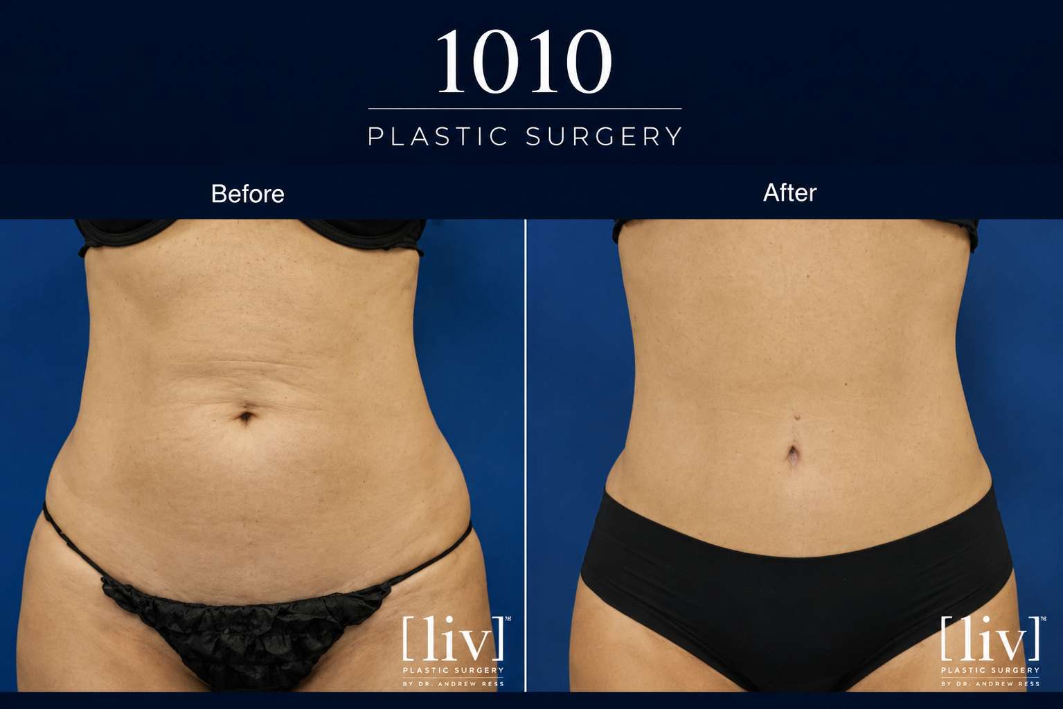 Body contouring before and after — 1010 Plastic Surgery