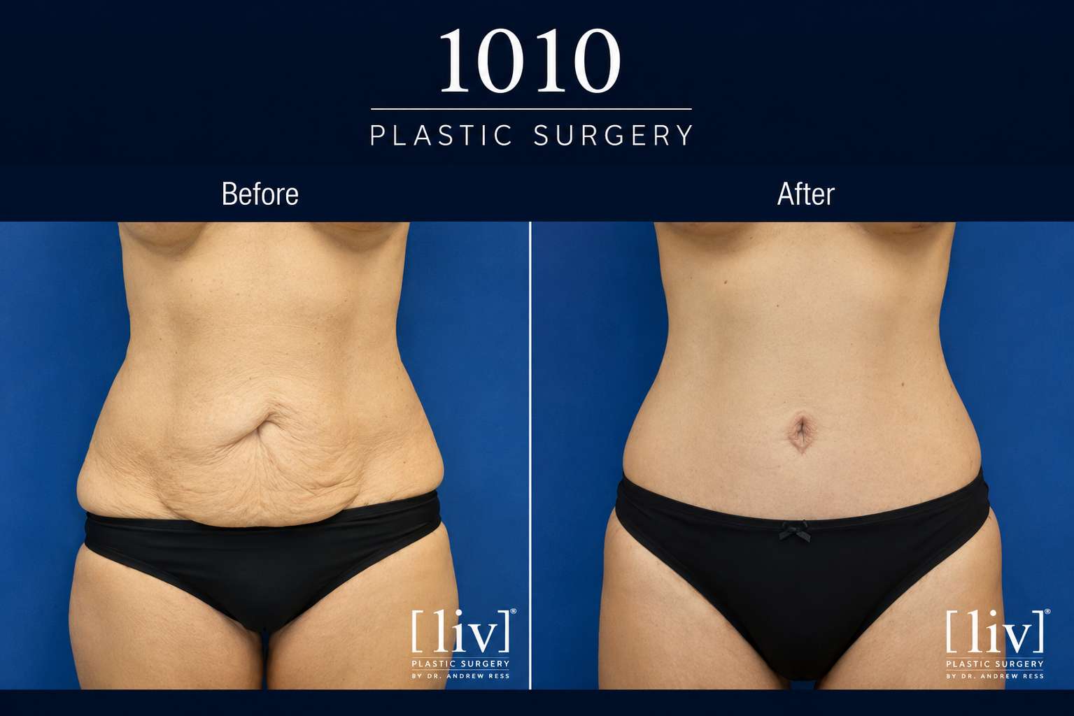 Body contouring before and after — 1010 Plastic Surgery