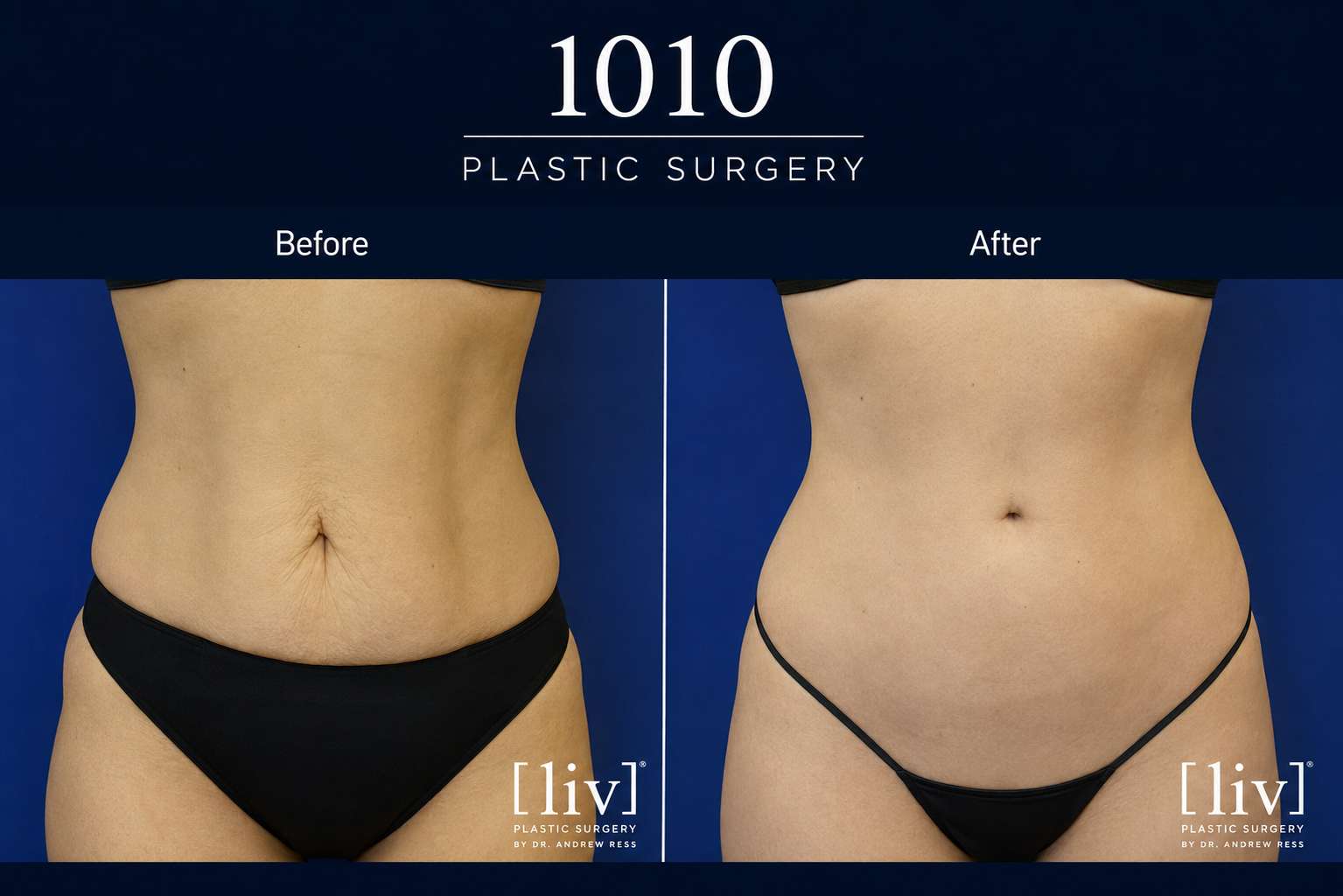 Body contouring before and after — 1010 Plastic Surgery